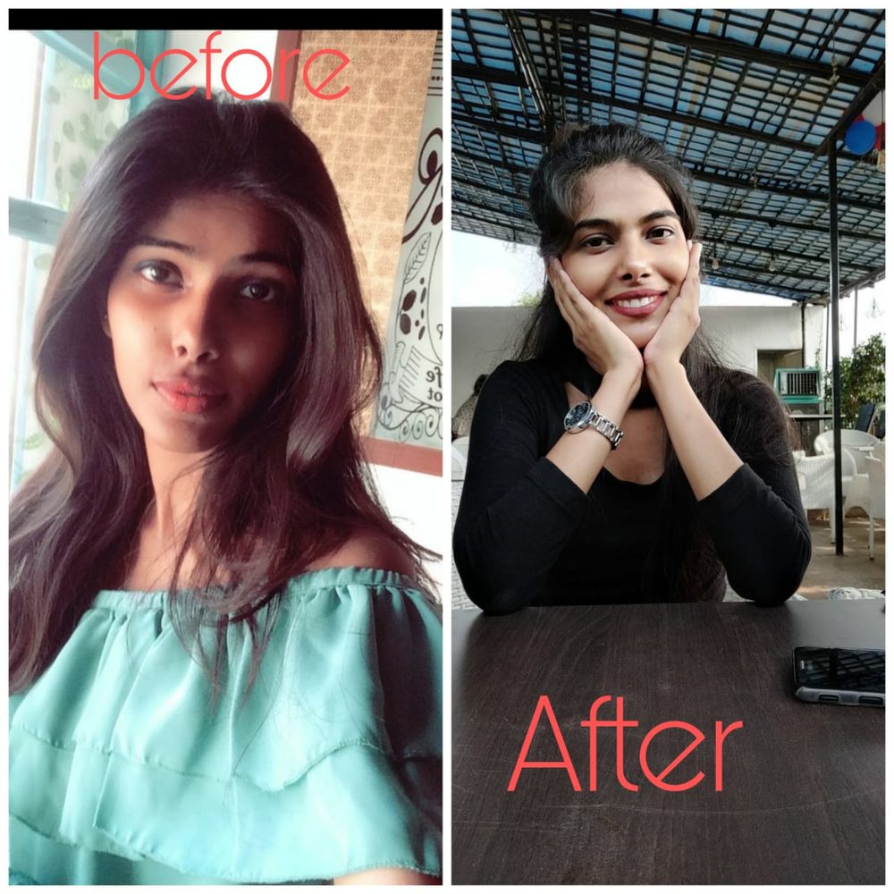 Real patient before and after photo shared after their treatment at Oro Care
