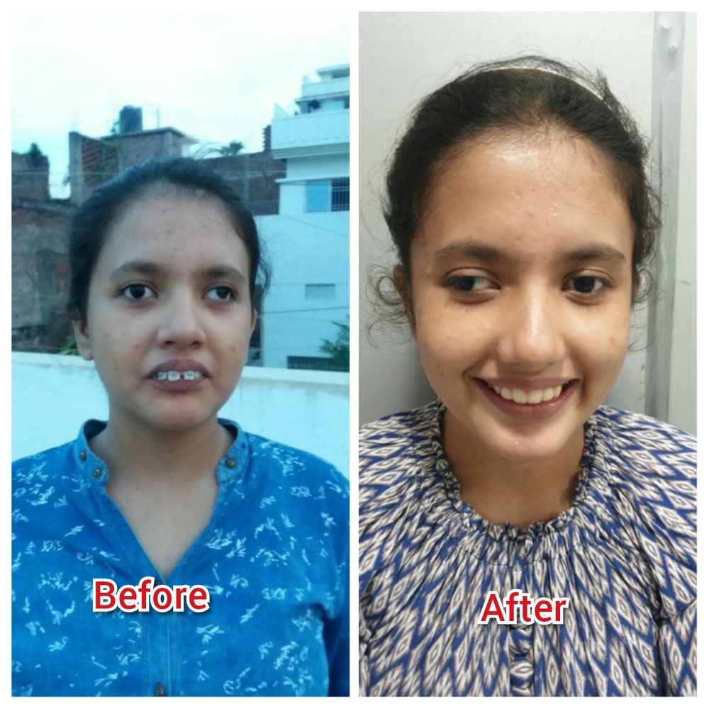 Real patient before and after orthodontic braces treatment, showing straighter teeth and a more confident smile
