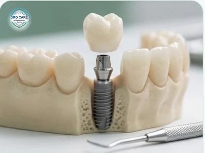 Single tooth implant model showing the titanium post and crown between natural teeth