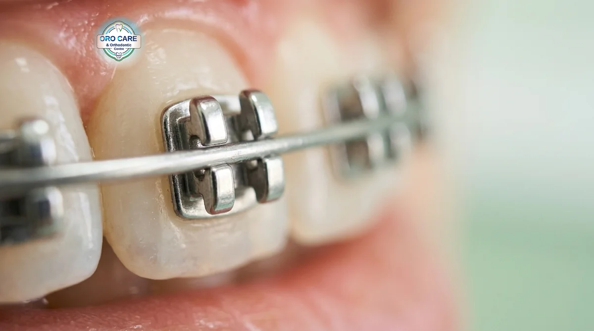 Close-up of traditional metal braces brackets and wire on teeth